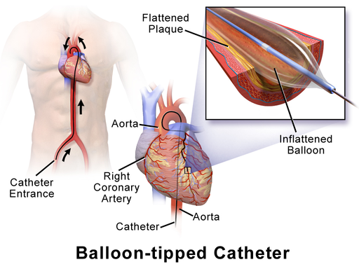 Balloon-Tipped Catheter