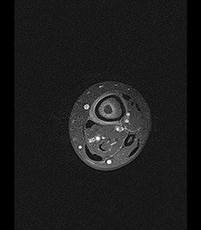 Axial T1-weighted fat-saturated MRI image following IV gadolinium contrast demonstrating the intramedullary lytic area seen on radiography to be ring enhancing consistent with a purulent fluid collection. Extensive circumferential periosteal enhancement is noted. There is also substantial bone marrow enhancement.