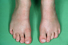 Picture of longitudinal ridging and splitting of the toenails as part of craniofrontonasal dysplasia. CFND toenail.jpg