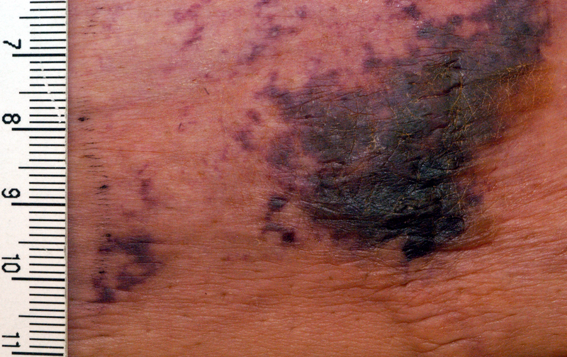File:Calciphylaxis.png