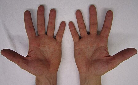 Characteristic rash of hand, foot, and mouth disease, on human hands.jpg