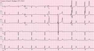 A 12-lead ECG of a person with CKD and a severe electrolyte imbalance: hyperkalemia (7.4 mmol/L) with hypocalcemia (1.6 mmol/L). The T-waves are peaked and the QT interval is prolonged. Combined hyperkalemia and hypocalcemia.png