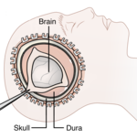 Illustration of Decompressive Craniectomy Surgery Decompressive Craniectomy.png