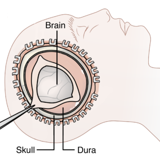 Decompressive craniectomy Neurosurgical procedure to treat swelling