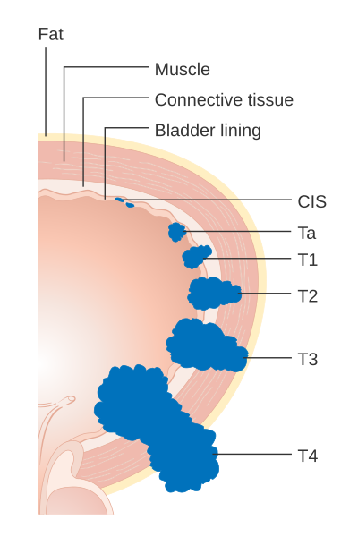 File:Diagram showing the T stages of bladder cancer CRUK ... head bone diagram 