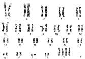Karyotype of tetrasomy X