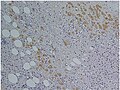 Immunohistochemical staining of trophozoites (brown) using specific anti–Entamoeba histolytica macrophage migration inhibitory factor antibodies in a patient with amebic colitis.