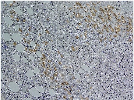 Immunohistochemical staining of trophozoites (brown) using specific anti–Entamoeba histolytica macrophage migration inhibitory factor antibodies in a patient with amebic colitis.