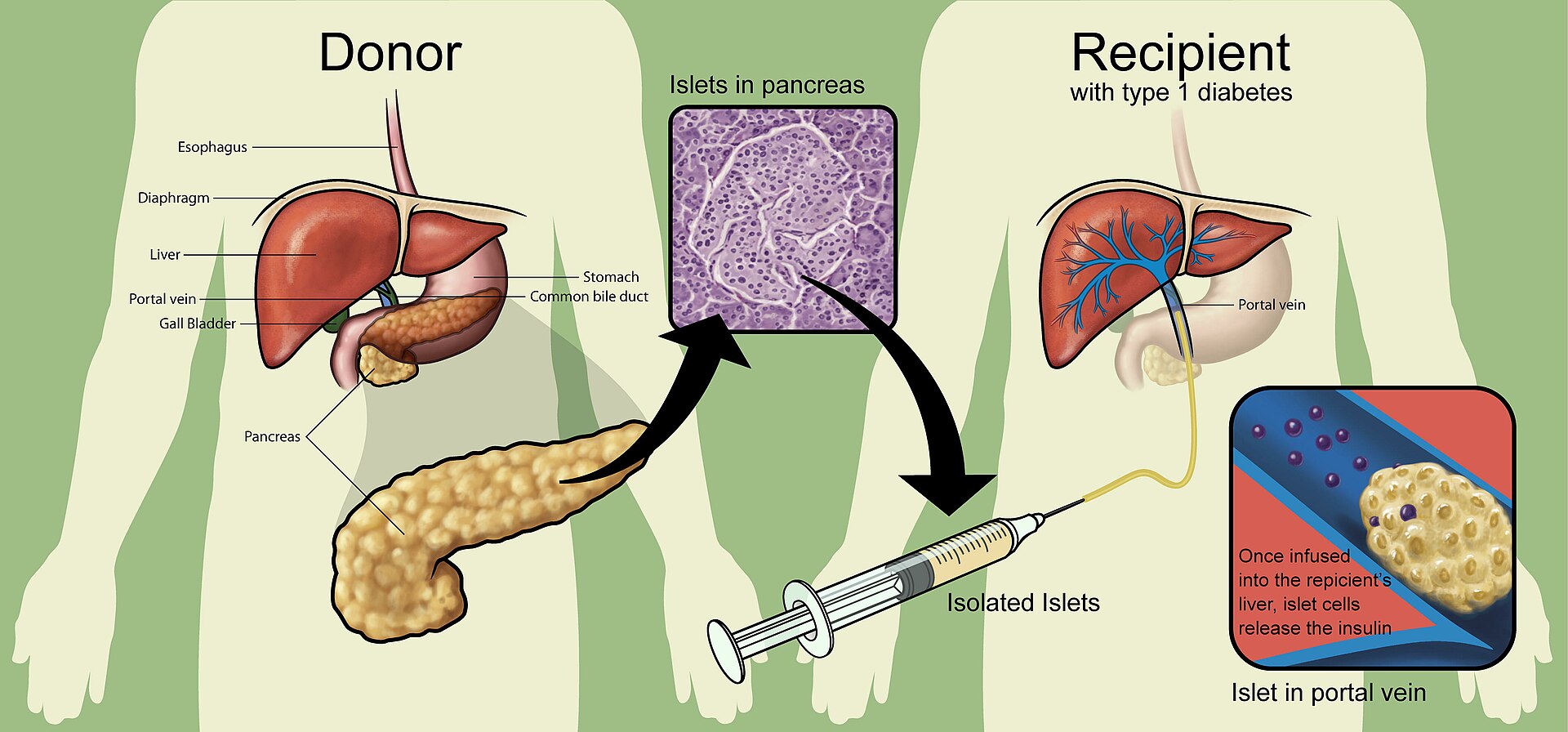 சர்க்கரையை வெல்லலாம் - Page 2 1920px-Islet_transplantation_PLoS_Medicine