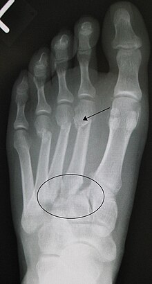 Lisfranc fracture (marked by the oval). This case also has fractures of the distal second (marked by the arrow), third, and fourth metatarsal bones. Lisfranc fracture.jpg