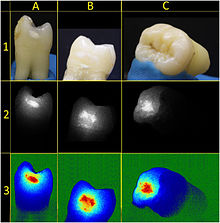 Tooth samples imaged with a non-coherent continuous light source (row 1), LSI (row 2) and pseudo-color visualization of LSI (row 3). Lp473524f2 online.jpg
