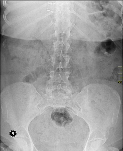 File:Medical X-Ray imaging DBR03 nevit.jpg