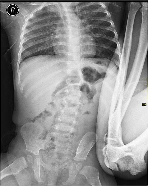 File:Medical X-Ray imaging TDX07 nevit.jpg