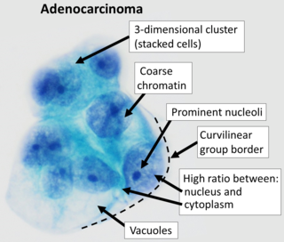 <span class="mw-page-title-main">Adenocarcinoma</span> Medical condition