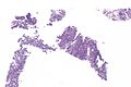 Pneumocytoma - low mag.