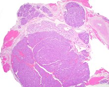 A hematoxylin and eosin stained slide of canalicular adenoma showing multifocality Salivary Canalicular Adenoma Multifocal.tif