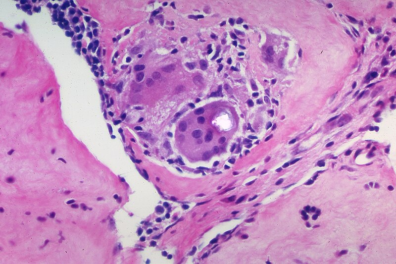 File:Sarcoidosis - Crystalline inclusion, polarized.jpg