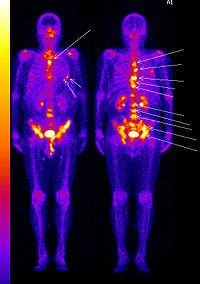 Osteoscintigraphy