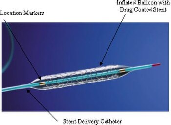 A coronary stent -- in this case a drug-eluting stent -- is another common item implanted in humans. Taxus stent FDA.jpg