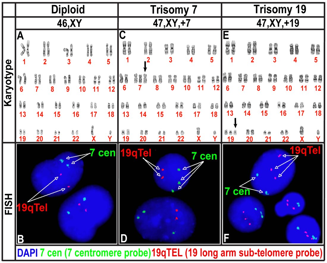 Trisomie