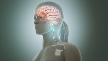 Vagus nerve stimulation.jpg