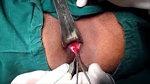 Anal Fissure Treatment-Lateral Sphincterotomy.jpg