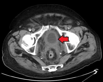 Bladder wall thickening due to cancer
