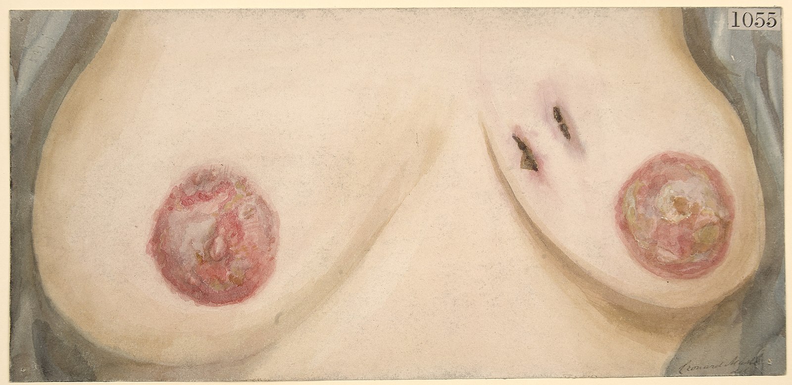 фурункул на груди у женщин фото 88