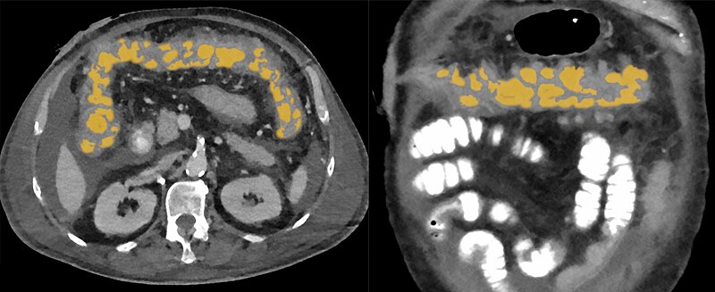 File:Clostridien Colitis 68M - CT KM pv - 001 - Annotation.jpg