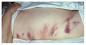Hemoragická pankreatitida - znamení Graye Turnera.jpg