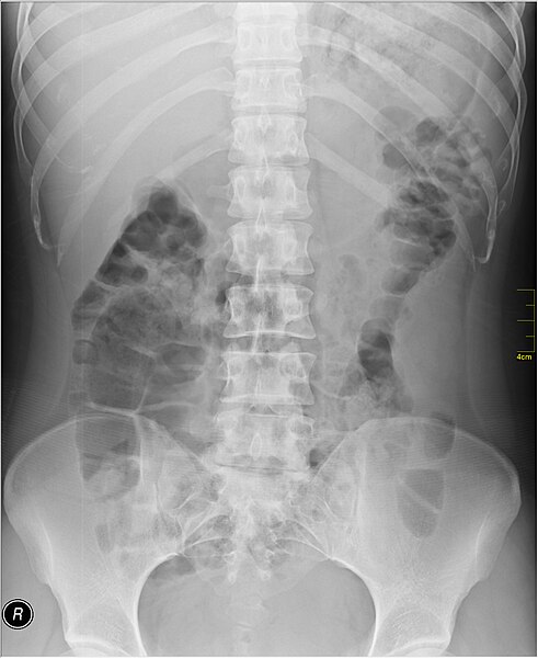 File:Medical X-Ray imaging VWA07 nevit.jpg