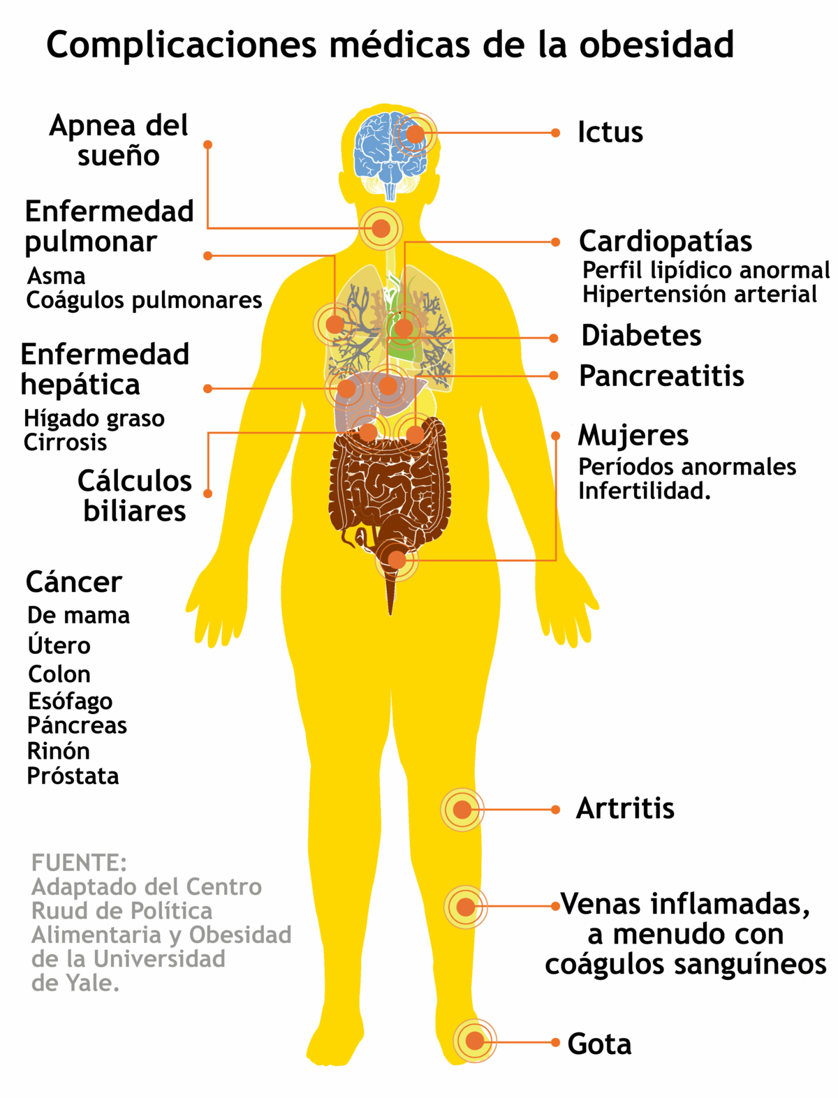 Obesidad y enfermedad cardiovascular - Artículos - IntraMed