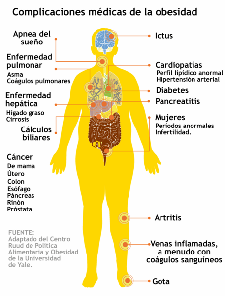 File:Medical complications of obesity-es.png