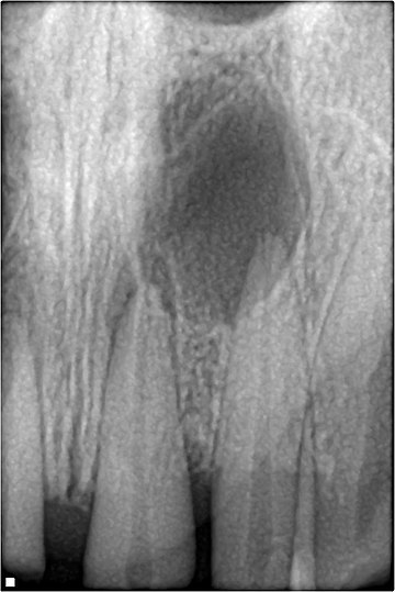 Odontogenic infection