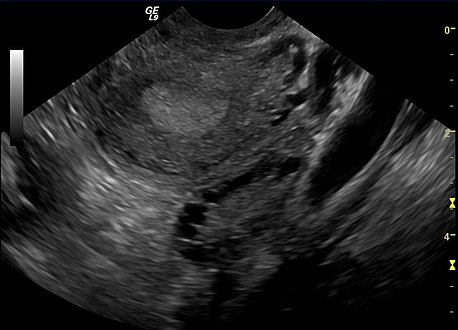 Transvaginal ultrasound scan of polycystic ovary