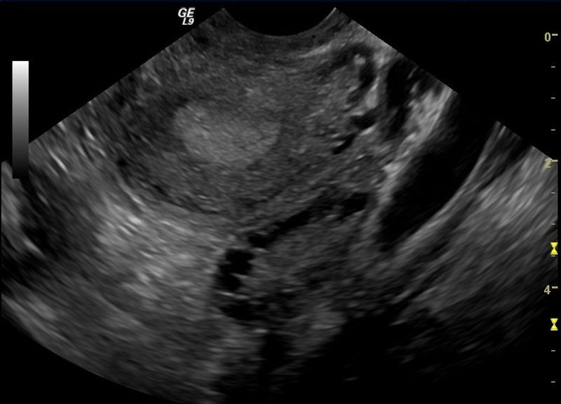 File:Polycystic ovary.jpg