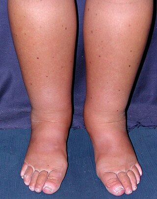 Primary intestinal lymphangiectasia (Waldmann's disease) - legs.jpg