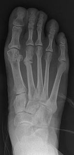 <span class="mw-page-title-main">March fracture</span> Medical condition