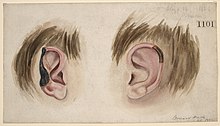 Dessins avec des oreilles dont une partie est noircie par la gangrène.