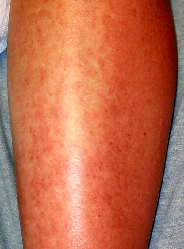 Allergic urticaria on the skin induced by an antibiotic