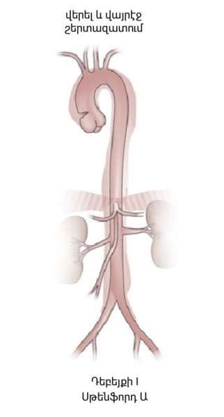 File:Aortic dissection of DeBakey type I (hy).png