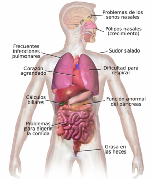 Fibrosis Quística: Síntomas y signos, Fisiopatología, Diagnóstico