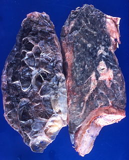 Pneumatosis Abnormal presence of air or other gas within tissues