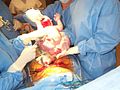 Complete extraction of the baby from the uterus