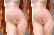 Location of a low transverse incision and midline vertical incision CesareasHorizontalyVertical.jpg