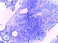 Cystic Hyperplasia of Endometrium 4x.jpg