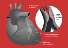 Heart attack diagram.png