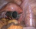 Thumbnail for Natural orifice transluminal endoscopic surgery