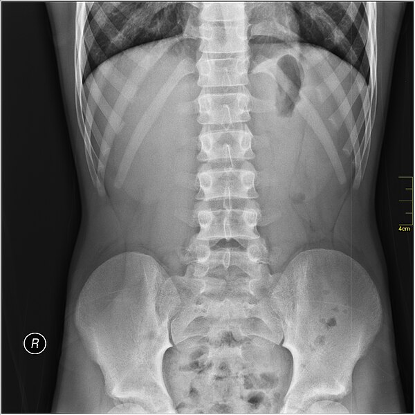 File:Medical X-Ray imaging XBM07 nevit.jpg