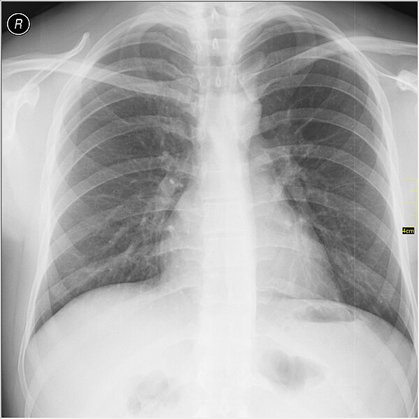 File:Medical X-Ray imaging XFT07 nevit.jpg